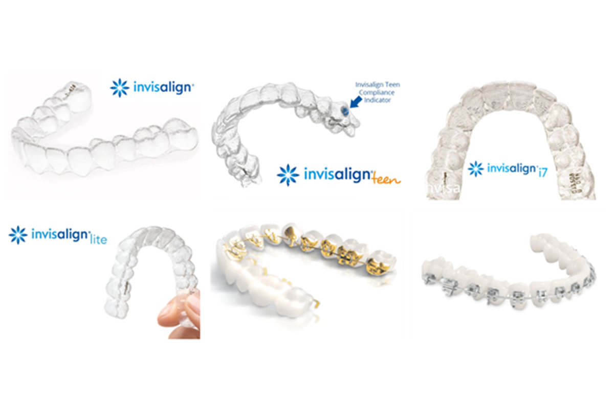 Types of Teeth Straightening for Adults in 2023