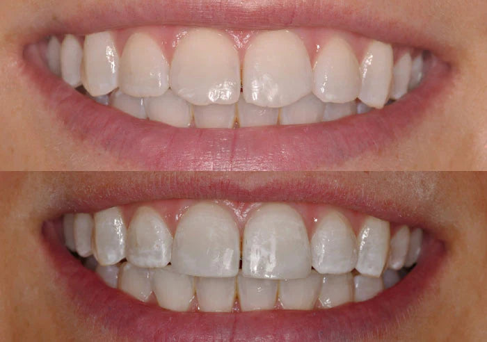 Composite restorations case study image