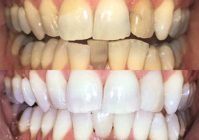 Smile makeover case study image