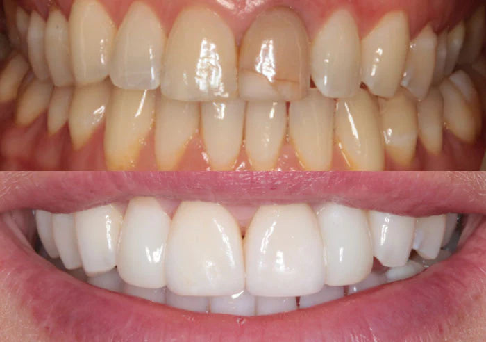 Whitening and veneers case study image