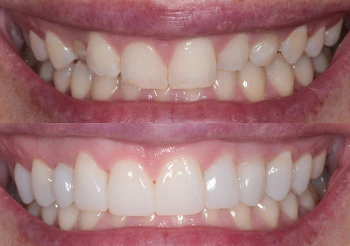 Veneers case study image