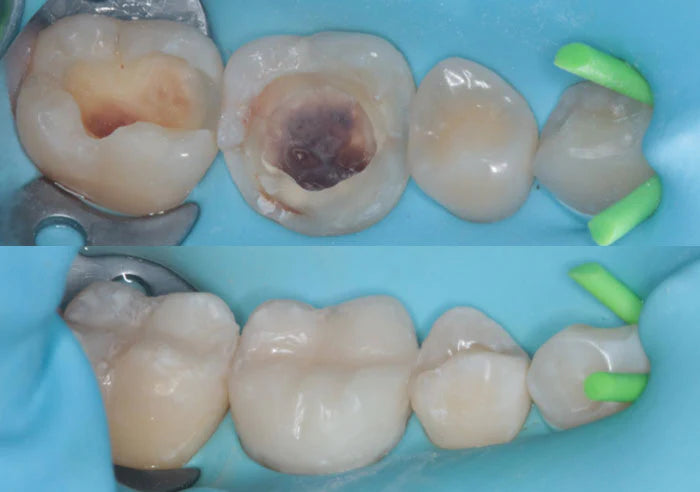 Composite Restorations case study image