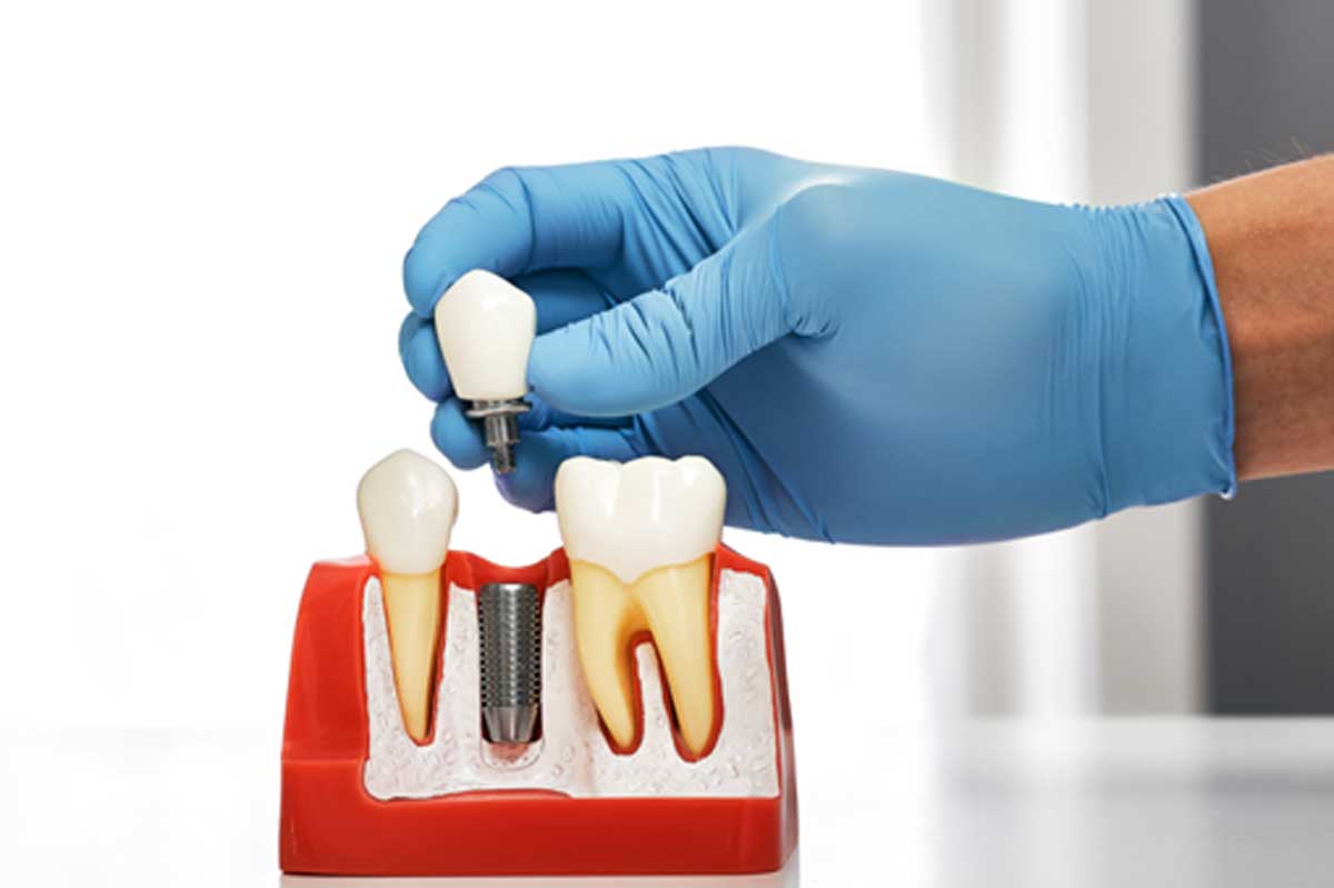 Dental implant model