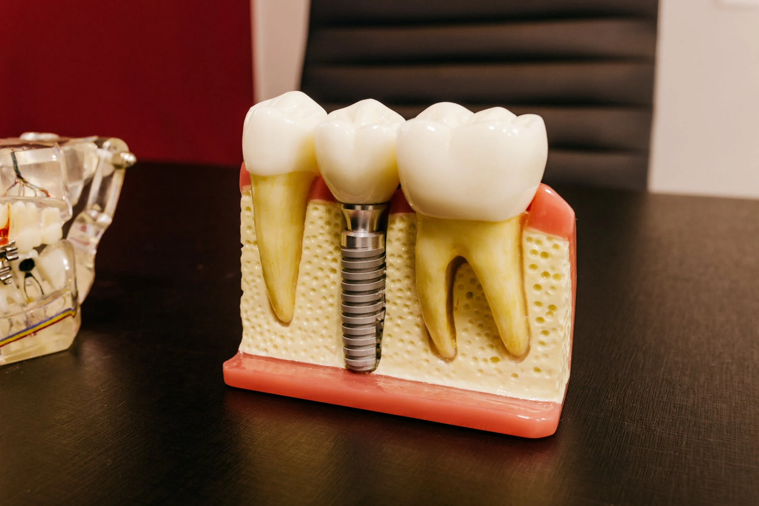 Model of a dental implant