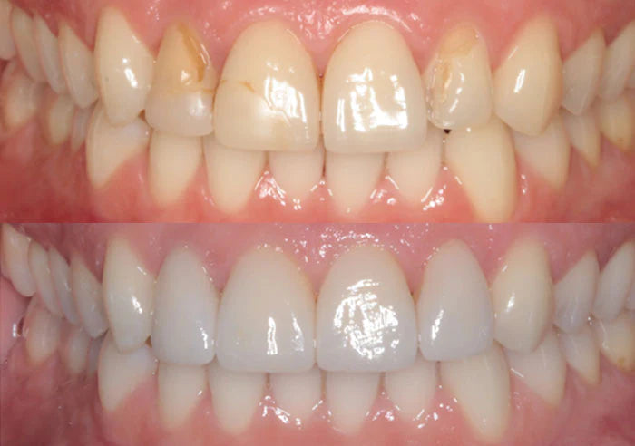 Whitening and veneers case study image