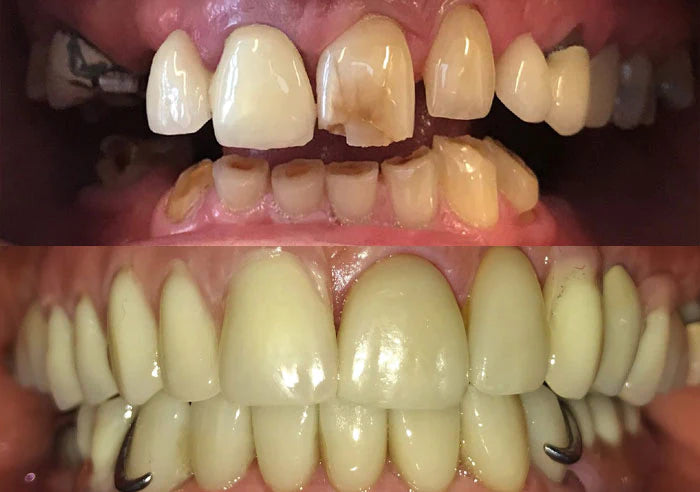 Crowns and dentures case study image