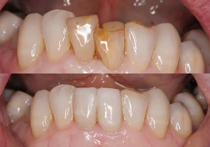 Dental veneers case study image