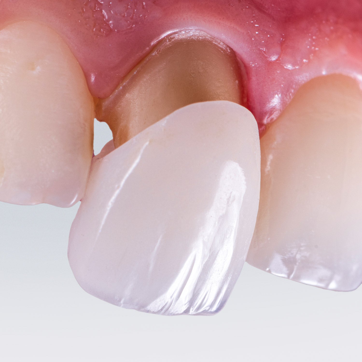 A dental crown